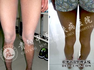 同学排斥我 竟是皮肤病在作祟