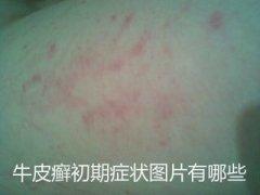 牛皮癣的初期症状有哪些图片类型3