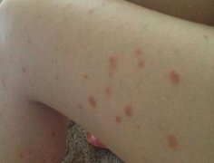 男性腿上牛皮癣症状图片