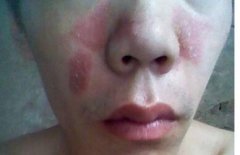 鼻子部位牛皮癣早期症状图片