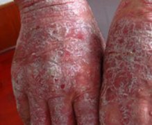 男性双手手背牛皮癣发红有鳞屑症状图片