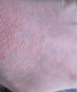 男性手腕银屑病发病初期症状图片