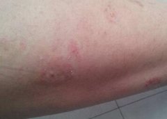 胳膊手臂寻常型牛皮癣早期症状图片
