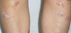 男性腿部牛皮癣硬皮斑块图片