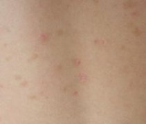 女性后腰牛皮癣初期起红点症状图片