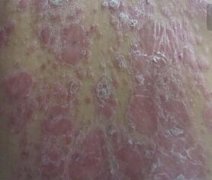 男性牛皮癣红皮起鳞屑症状图片