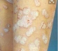男性胳膊牛皮癣多斑块掉屑症状图片