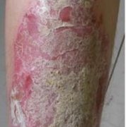 腿部牛皮癣症状图片大全