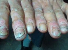 关节型牛皮癣的症状图片