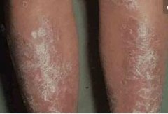 男性腿部牛皮癣掉屑瘙痒症状图片
