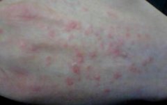 女性手背牛皮癣点滴状图片