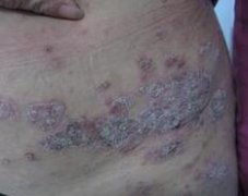男性腰部牛皮癣发病初期症状图片