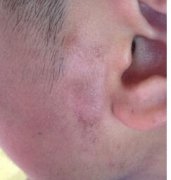 耳朵部位牛皮癣早期症状图片