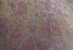 女性后腰牛皮癣成片掉屑症状图片