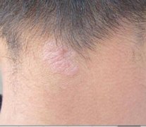 脖子牛皮癣初期症状图片