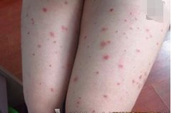 女性大腿根部牛皮癣多红点症状图片