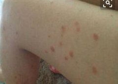 女性腿部牛皮癣小红点症状图片