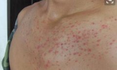 男性牛皮癣脖子下方多斑点症状图片
