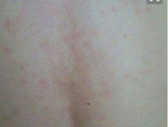 女性背部牛皮癣好转症状图片