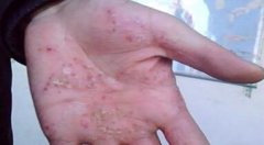 男性手指心牛皮癣症状图片