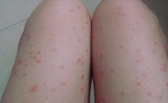 女性双腿牛皮癣多斑点初期症状图片