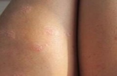女性腿部牛皮癣初期症状图片