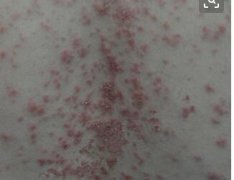 女性牛皮癣腰部小红点症状图片