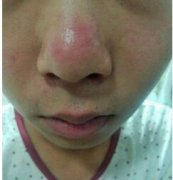 鼻子部位牛皮癣早期症状图片