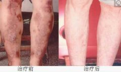 男性腿部治疗前后对比图