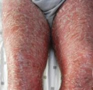 男性腿部遍布牛皮癣症状图片