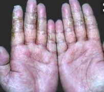男性牛皮癣双手手指脱屑症状图片
