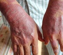 男性双手手背牛皮癣治疗后有黑斑图片