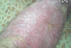 男性腿部牛皮癣成片鳞屑症状图片