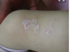 儿童膝盖牛皮癣掉屑瘙痒症状图片