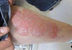 腿上长了很多红斑是不是牛皮癣
