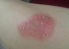 腿部银屑病症状图片