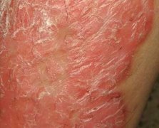 女性牛皮癣硬皮红斑块症状图片