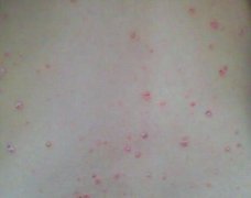 男性背部牛皮癣点滴状图片