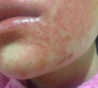女性下巴部位牛皮癣早期症状图片