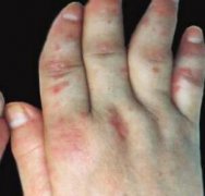 关节型牛皮癣的症状图片