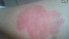男性腿部牛皮癣大红斑块症状图片