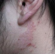 耳朵部位牛皮癣早期症状图片
