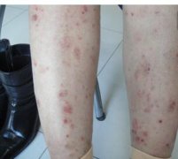 女性腿部牛皮癣发病初期症状图片