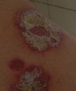 男性腿部牛皮癣大斑块症状图片