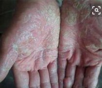 手部牛皮癣症状图片大全
