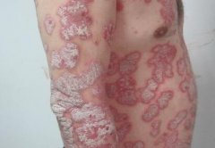 男性上半身全身斑块状牛皮癣症状图片