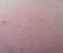 男性腰部牛皮癣初期症状图片
