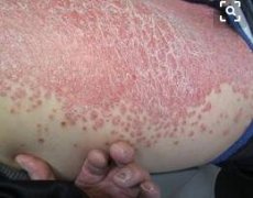 青年人牛皮癣症状图片