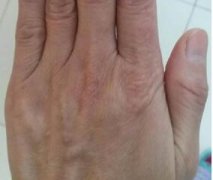 手背寻常型牛皮癣早期症状图片
