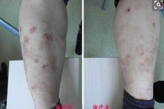 男性牛皮癣中医调理2疗程后治疗对比图